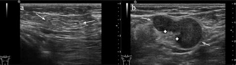 Illustration Of Axillary Lymph Nodes On Ultrasound A Illustration Of