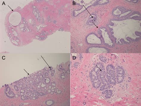 Fibrocystic Change The Spectrum Of Histologic Findings Seen With