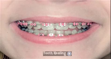 The Benefits Of Hot Pink Braces Confidence Boosting And Fashionable Teeth Healing