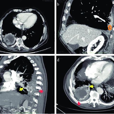 A Axial Contrast Enhanced Ct Scan Heterogeneous Well Capsulated