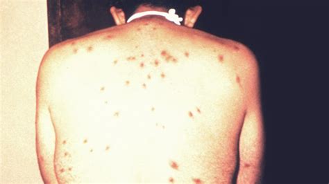 Hiv Rash Types Causes Other Symptoms When To See A Doctor Vrogue