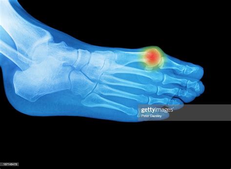 Foot Xray With An Area Of Pain Or Swelling High Res Stock Photo Getty