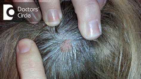 What Does Small Skin Colored Lump On The Scalp Indicate Dr Urmila