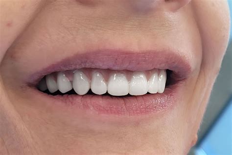 Denti Fissi In 6 Ore Implantologia A Carico Immediato Wedental Care