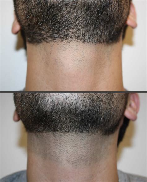 Check spelling or type a new query. Laser Hair Removal - Neck | Before & After - Hair | Laser ...