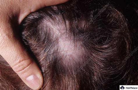 Lupus Hair Loss Causes Symptoms And Treatment Options