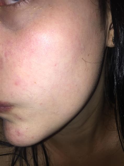 Rednessirritated Appearance On Face Rosacea And Facial Redness Acne