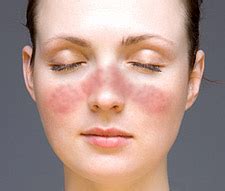 Lupus is a chronic autoimmune condition that causes inflammation throughout your body. Systemic lupus erythematosus - wikidoc