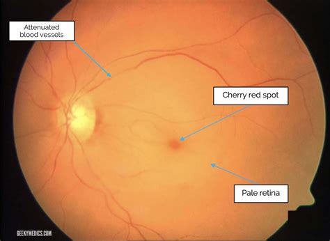 Central Retinal Artery Occlusion Vs Normal