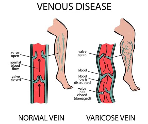 Leg Pain 7 Bad Habits That Can Make It Worse