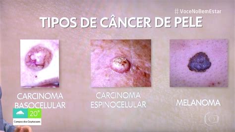 Entenda os tipos de câncer de pele Bem Estar G