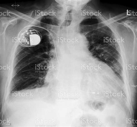 Chest With Pacemaker On Xray Stock Photo Download Image Now Medical