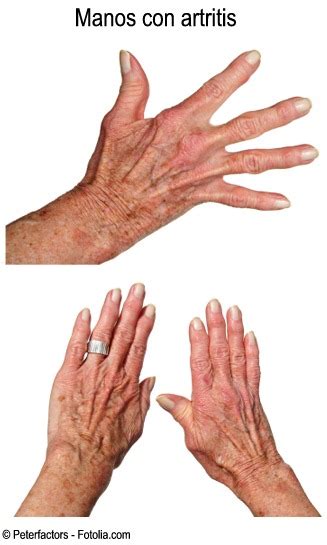1.2 qué enfermedad causa dolor de articulaciones. Enciclopedia Salud: Artrosis y Artritis