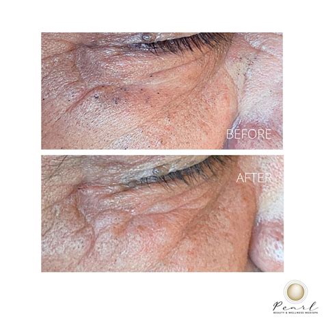 Facials Brisbane, Specialist Acne Extraction Facial & Blackhead Removal