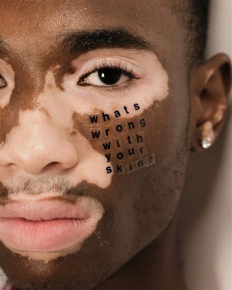 Peter Devito Photo Series Vitiligo Face Skin