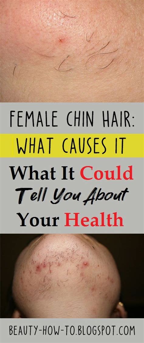 If the hair is coarse and dark, laser is the most effective treatment, inducing a gradual decrease in hair growth, resulting in finer, lighter hair on the face, elizabeth concludes. Female Chin Hair: What Causes It and What It Could Tell ...