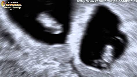 2d Ultrasound 6 Weeks Pregnant Twins Funny Rafael Ortega Muñoz Md 6