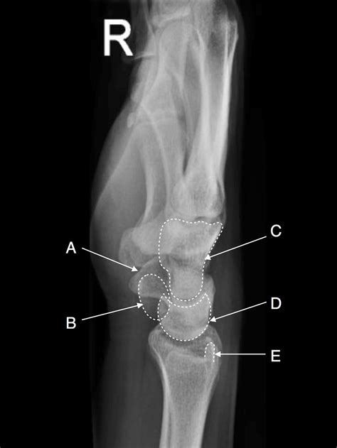 Radiographic Anatomy Of The Skeleton Wrist Lateral View Labelled Porn
