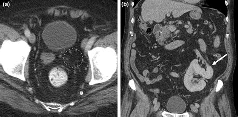 A Axial Contrast Enhanced Ct Images Through The Pelvis Shows Congenital