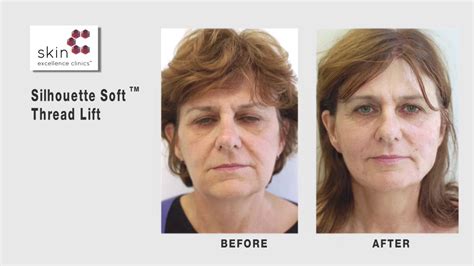 How To Get Rid Of Jowls Without Surgery Dr Ian Strawford Skin