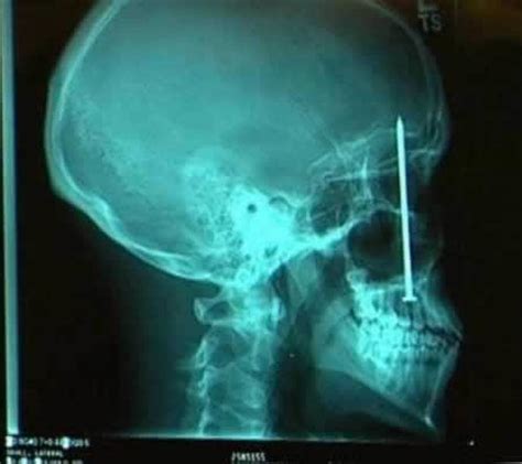 Real X Rays That Will Shock And Astound You 21 Pics Izispicy Com