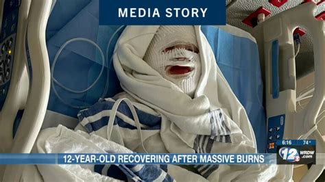 Jms Burn Center In Augusta Featured On Wrdw Burn And Reconstructive Centers Of America
