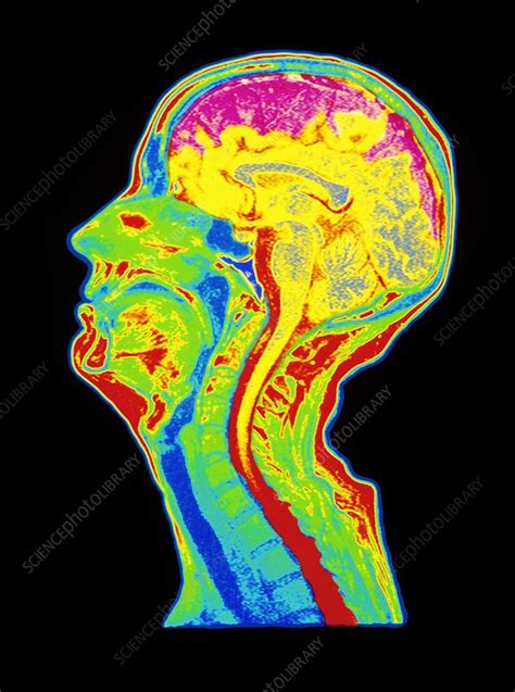 Coloured Mri Scan Of A Brain With Cerebral Atrophy Stock Image M108