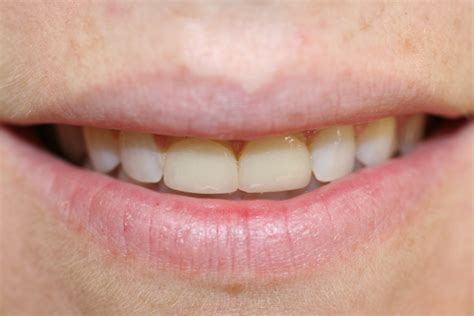 Once properly created they are bonded to the tooth's it's important to educate yourself on the different types of veneers offered so you understand the costs, the benefits, any negativity that may come with. Veneers & Lumineers | Pearl Cosmetic DDS