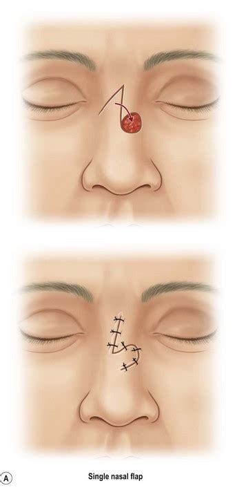 Aesthetic Nasal Reconstruction Plastic Surgery Key