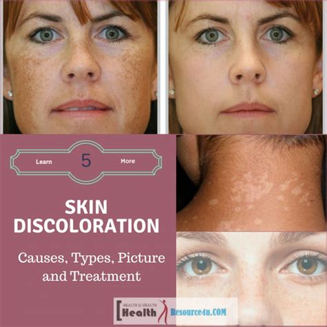 Types Of Skin Discoloration