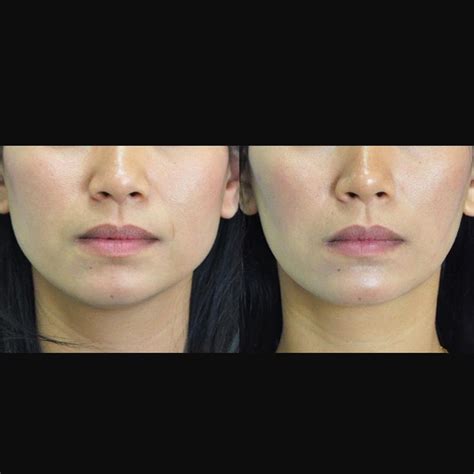 Botox Injections In The Masseter Muscles Can Be Used To Address