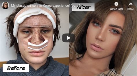 Id Hospital Korea Amazing Transgender Plastic Surgery Transformation