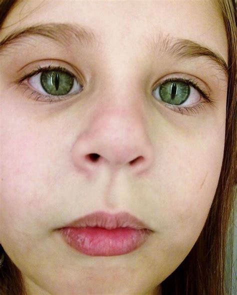 It's also a good idea to remove the irritant from the home if you are aware of what is causing their. Cat eye syndrome (CES), or (Schmid-Fraccaro syndrome) is a ...