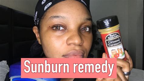 How To Get Rid Of Sunburn Fast On The Face Natural Home Remedy For