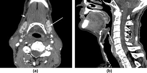 Imaging Of The Post Treatment Neck Clinical Radiology
