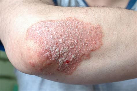 A Huge Spot Of Psoriasis On The Elbowexacerbation Of The Disease Stock