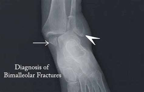 Bimalleolar Fracture Broken Ankle Causes Symptoms Diagnosis Treatment
