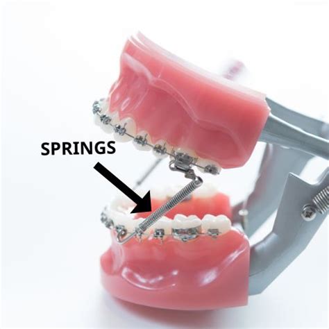 The Ultimate Guide To The Parts Of Braces Frey Orthodontics