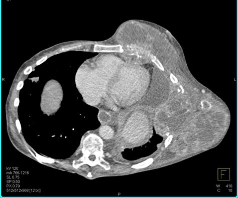 Sarcoma Involves The Chest Wall Chest Case Studies Ctisus Ct Scanning