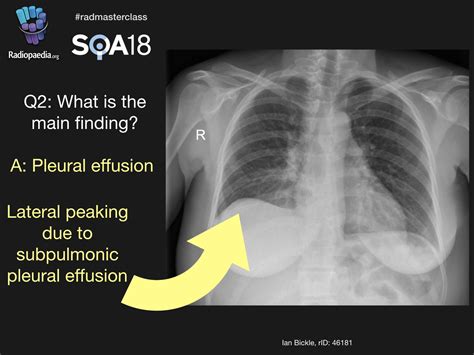 Pleural Effusion X Ray Lateral