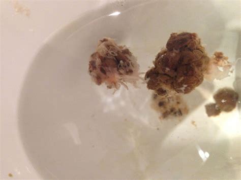 What Is This White Stuff In My Stool Ask Humaworm Parasites 730