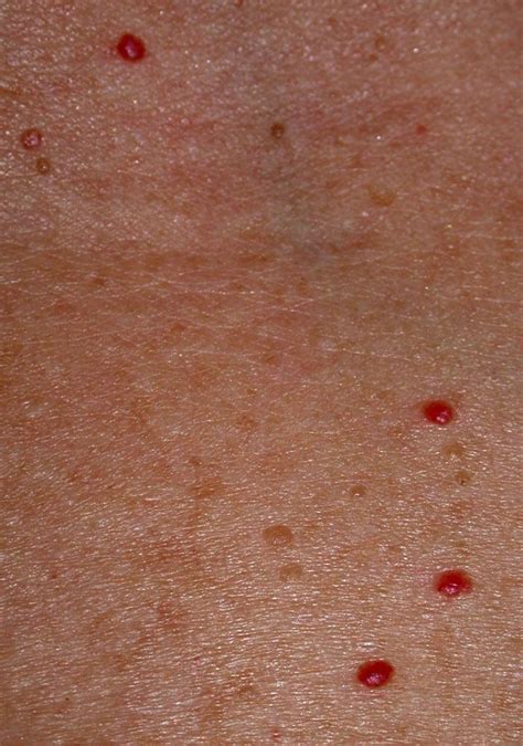 An Example Of Cherry Angiomas Campbell De Morgan Spots Health