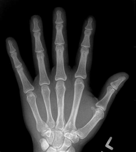 What Does Hand Arthritis Look Like On X Ray John Erickson Md
