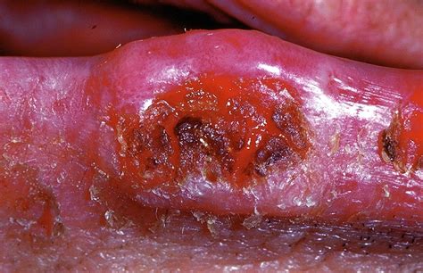 Squamous Cell Carcinoma Clinical Features Wikidoc