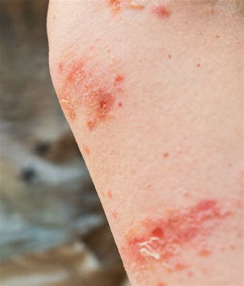 Poison Ivy Poison Oak Treatments BeWell Immediate Care