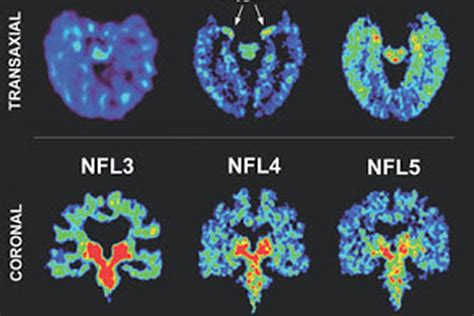I'm 39 & i'll happily take the astrazeneca vaccine. Ready for some head trauma? What to make of CTE in the NFL ...