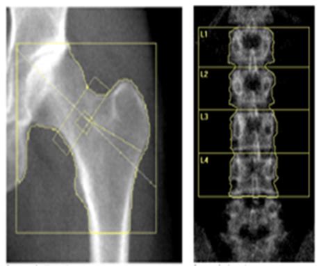 If you do have bone loss, you may be offered drug. Hormone treatment restores bone density for young women ...