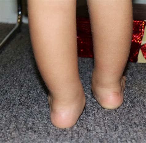 Help My Toddlers Feet Looks Odd And He Walks Funny My Favourite Physio