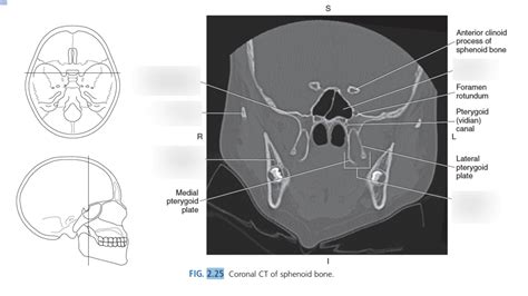 Coronal Ct Of Sphenoid Bone Diagram Quizlet