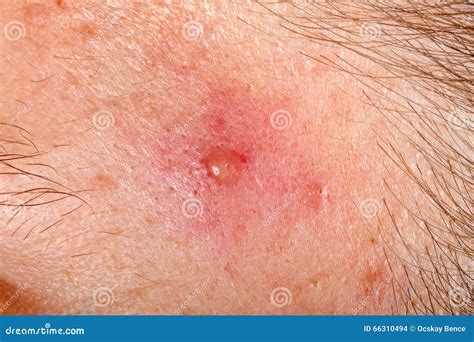 Nodular Cystic Acne Skin Stock Photo Image Of Anthrax 66310494